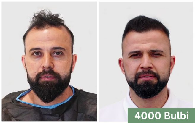 Trapianto di capelli prima e dopo 1