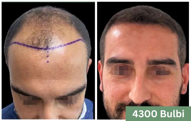 Trapianto di capelli prima e dopo 10