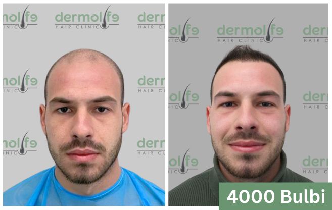 Trapianto di capelli prima e dopo 12