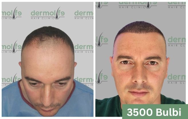 Trapianto di capelli prima e dopo 13