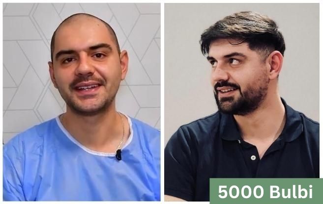 Trapianto di capelli prima e dopo 15