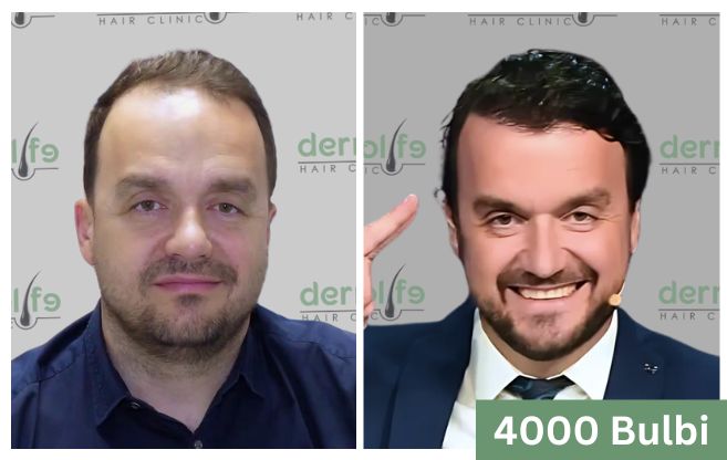 Trapianto di capelli prima e dopo 18