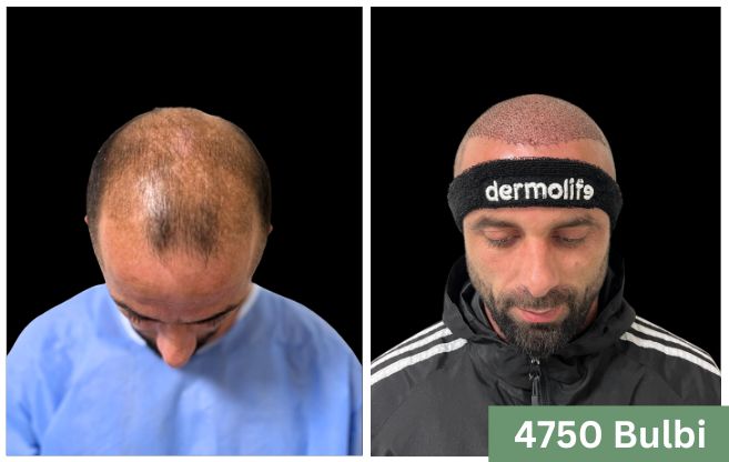 Trapianto di capelli prima e dopo 2
