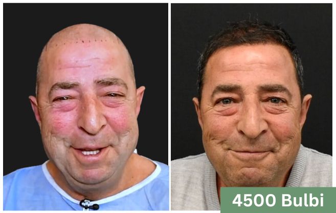 Trapianto di capelli prima e dopo 20