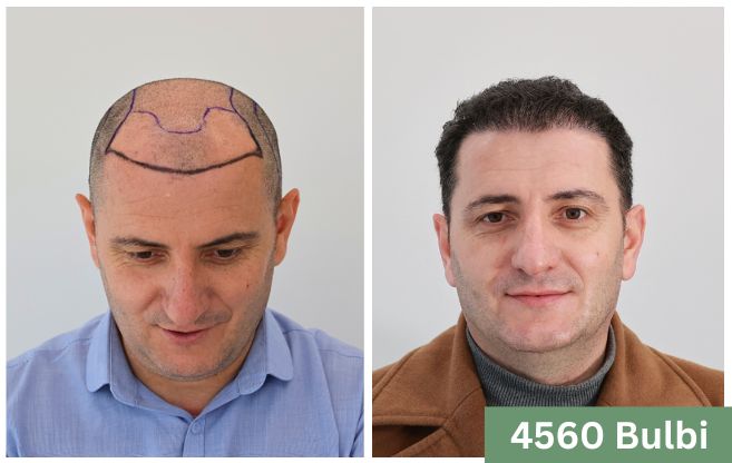 Trapianto di capelli prima e dopo 7