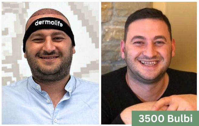 Trapianto di capelli prima e dopo 9