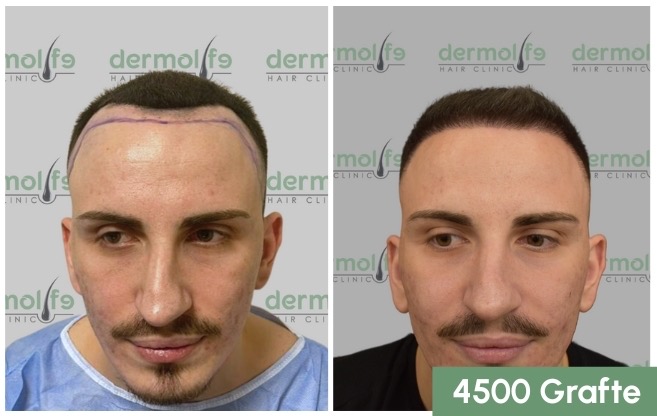 Mbjellja e flokut ne Shqiperi