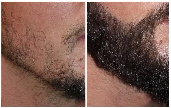 rezultate para pas mbjelljes se mjekres