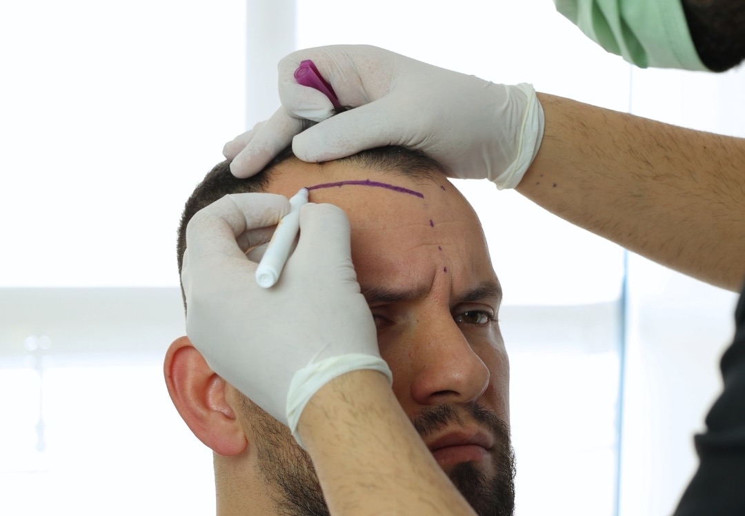 pergatitja per proceduren e transplantit te flokeve