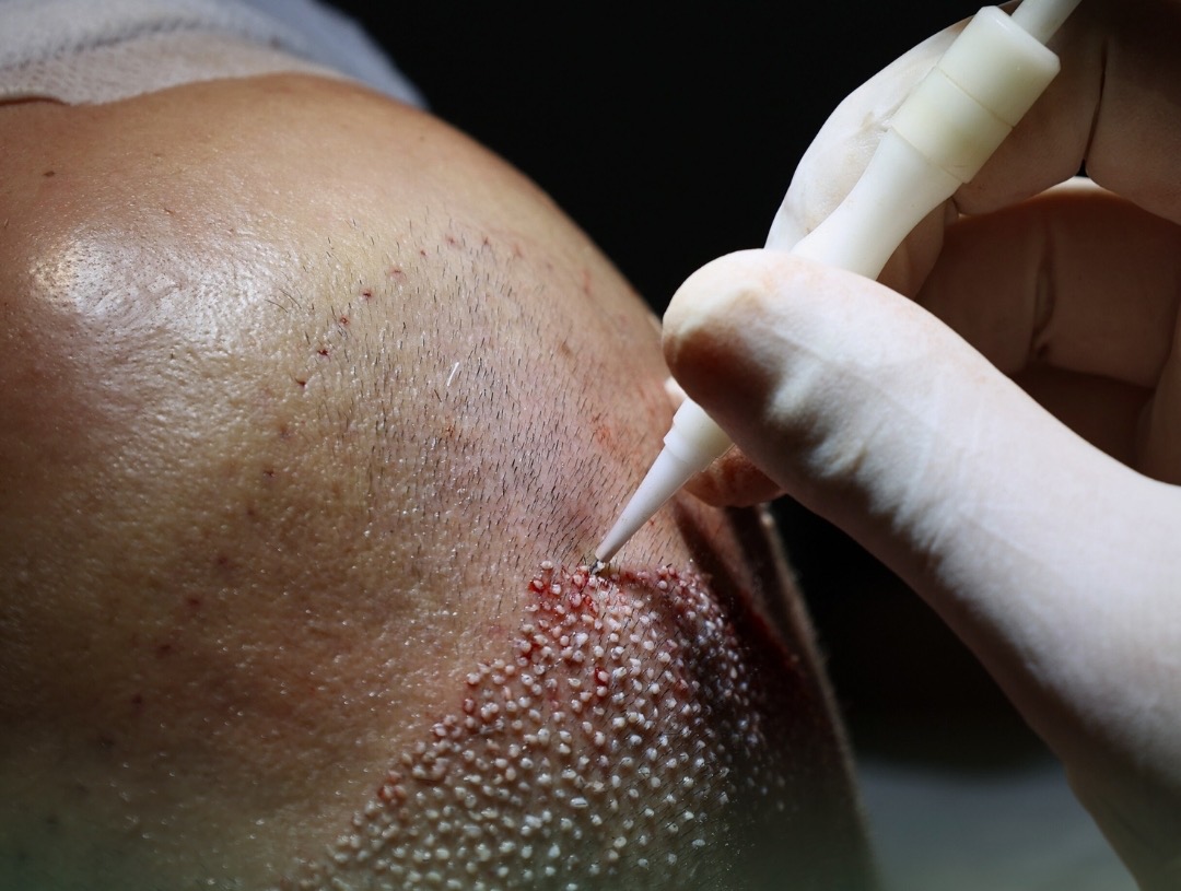 Perse te zgjedhim metoden DHI