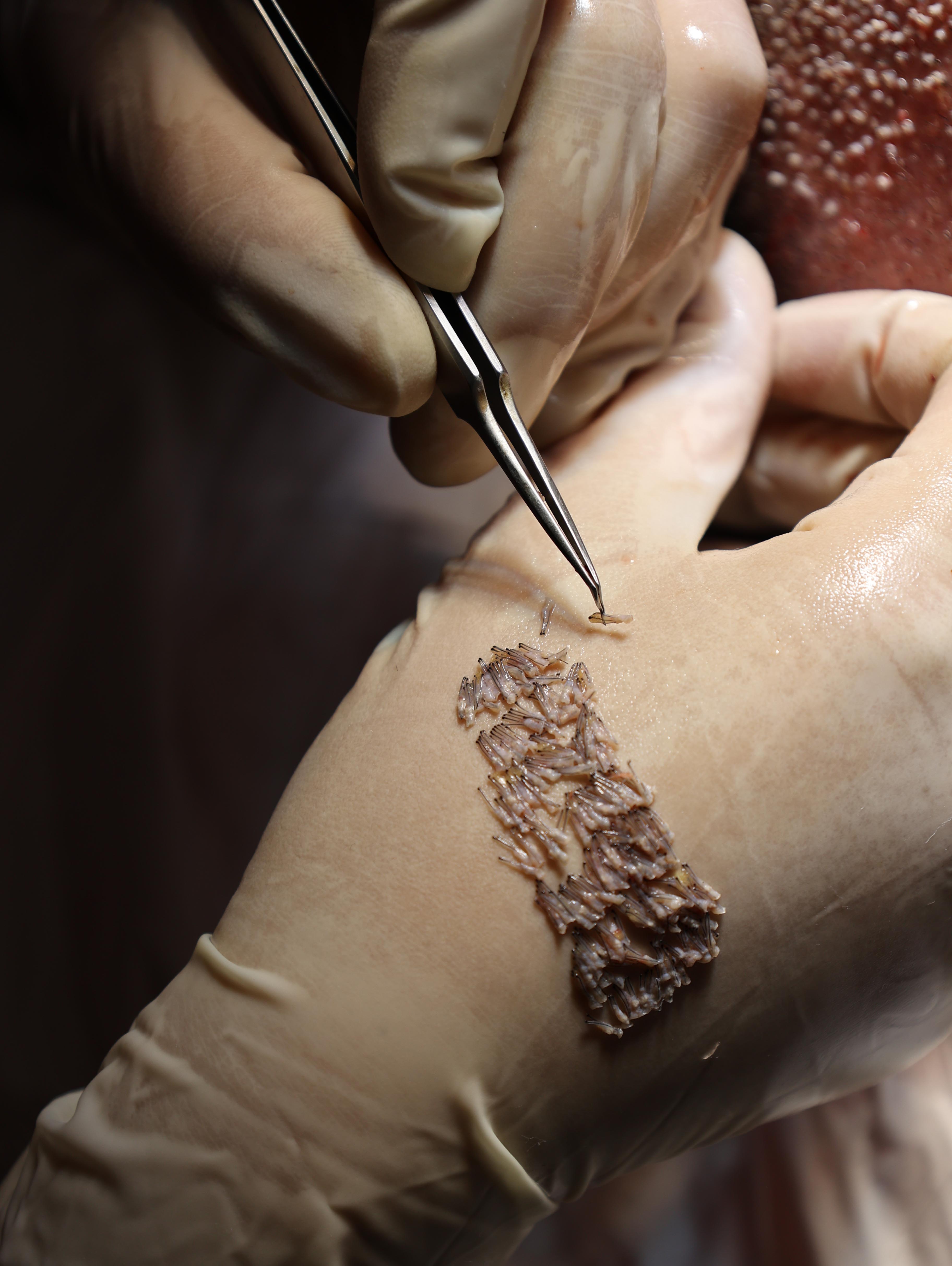 Metoda FUE për transplantin e flokëve