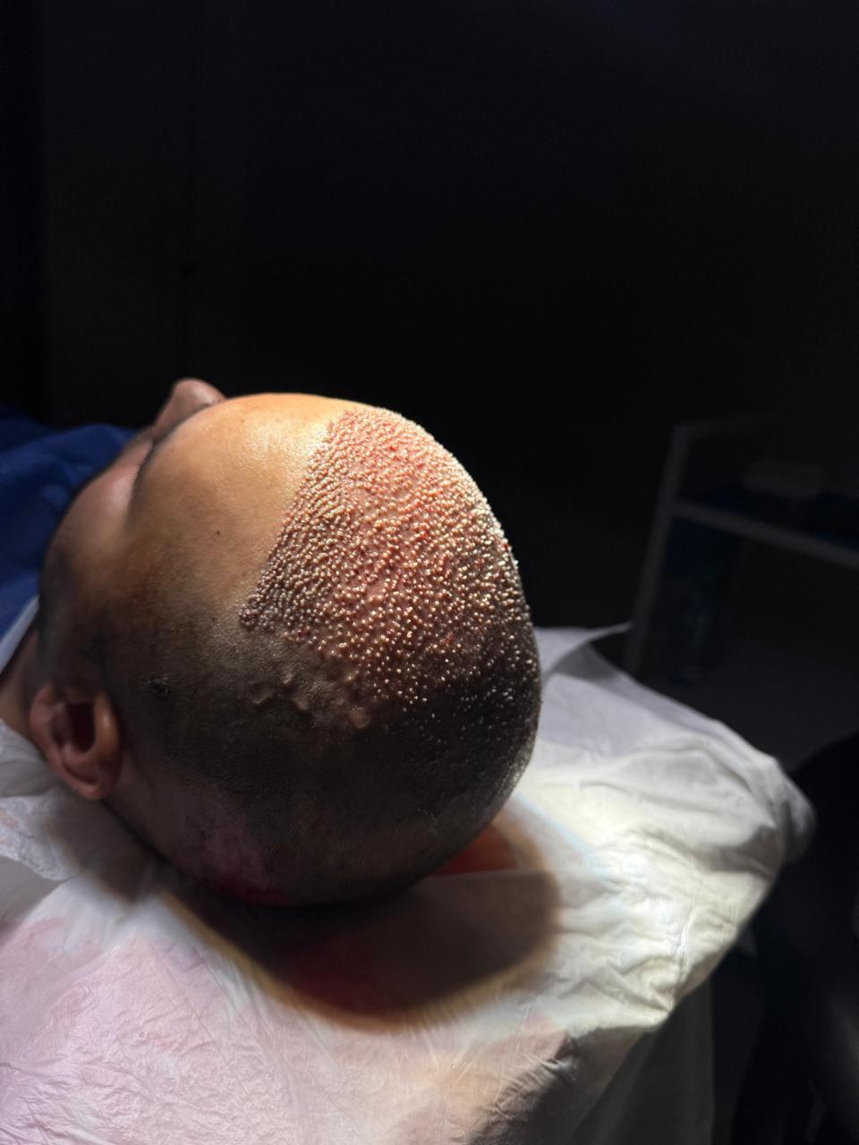 Procedura FUE dhe nxjerrja e grafteve