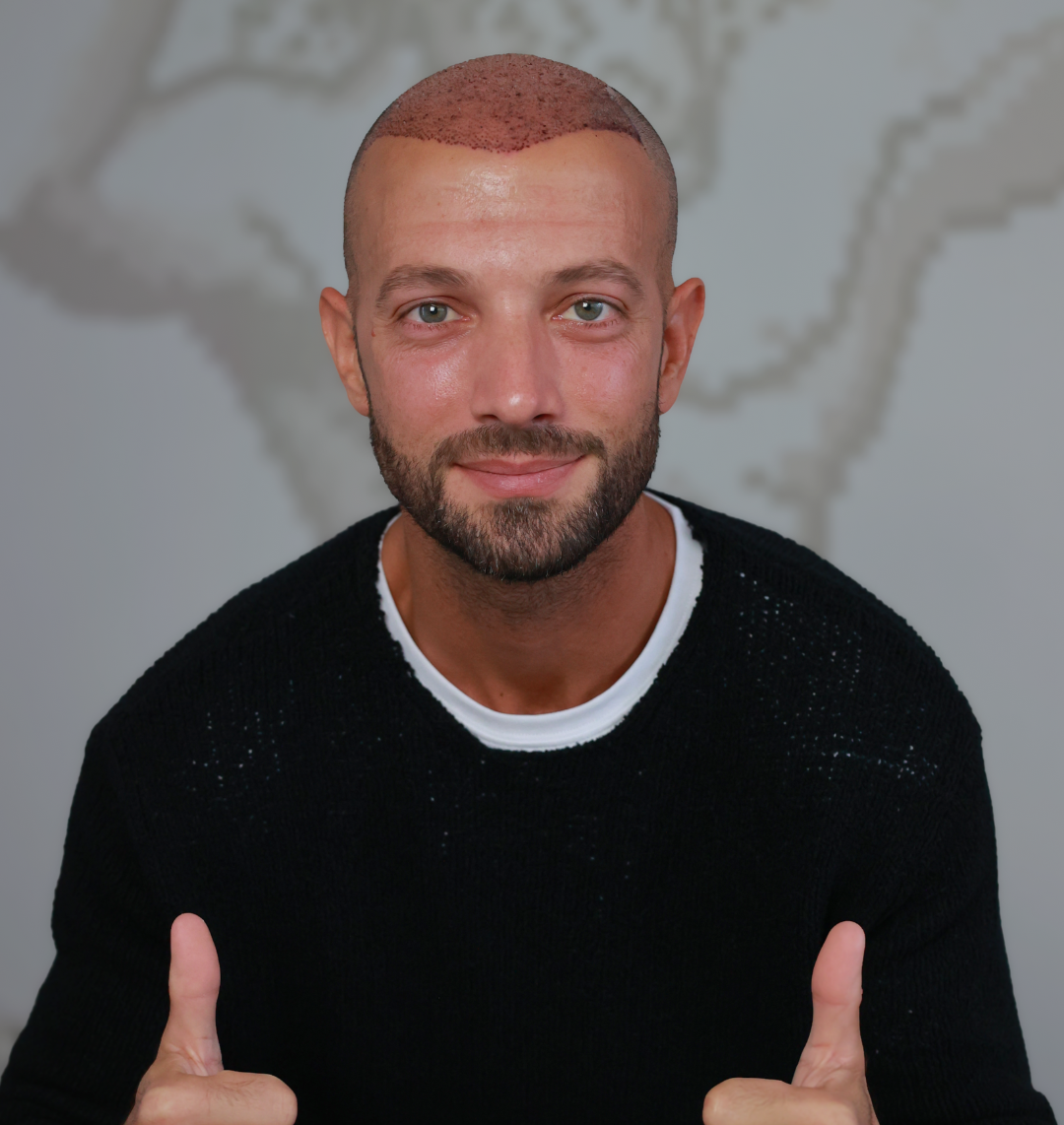 Rikuperimi pas transplantit të flokëve