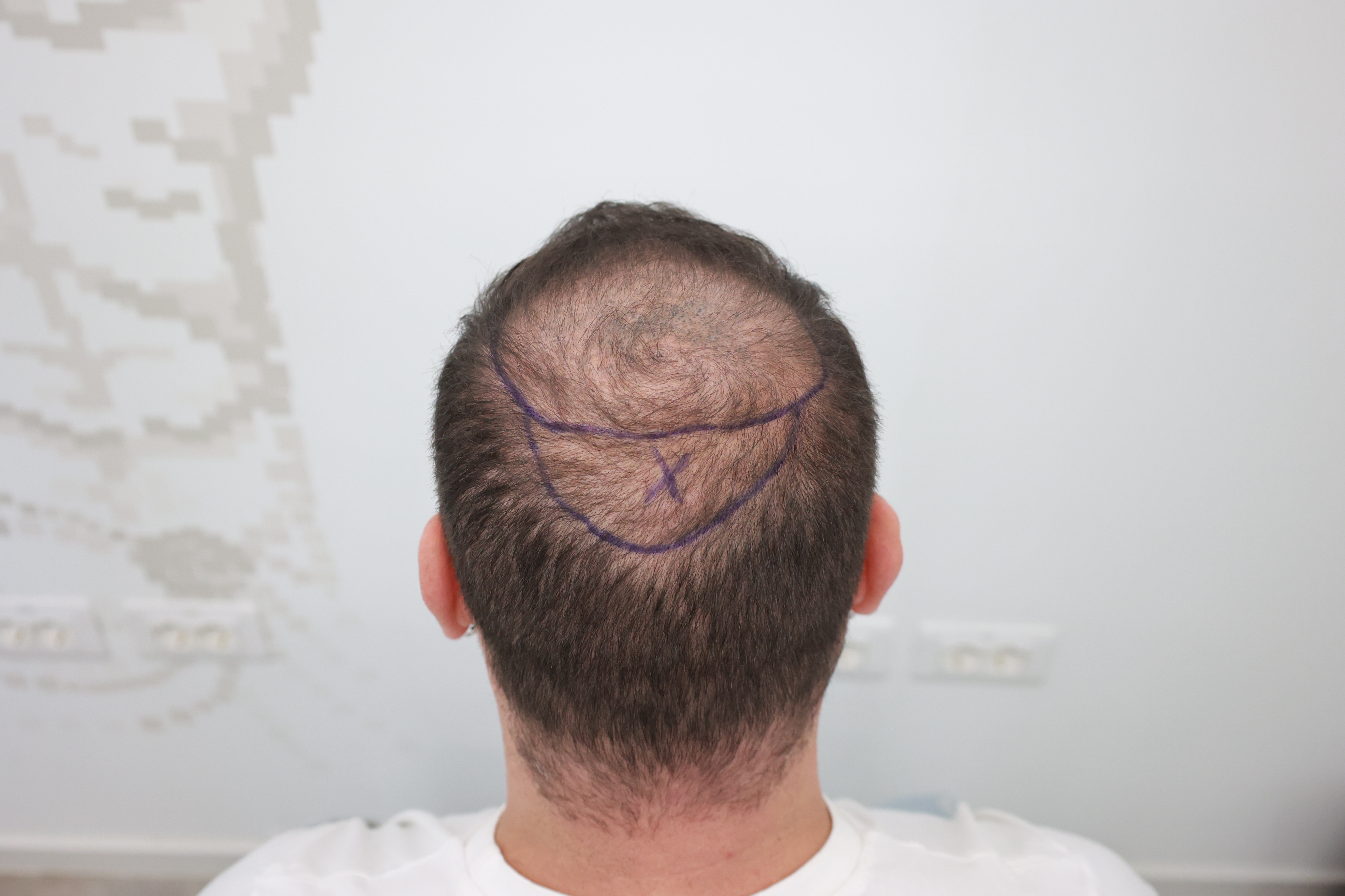 Transplanti i flokëve për pacientët me diabet